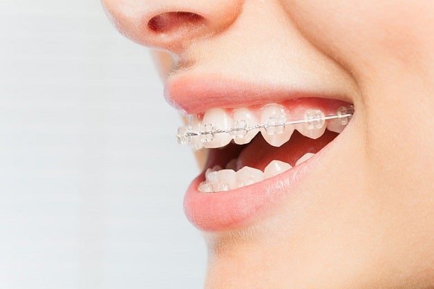 Niềng răng mắc cài sứ cải thiện những nhược điểm ở răng