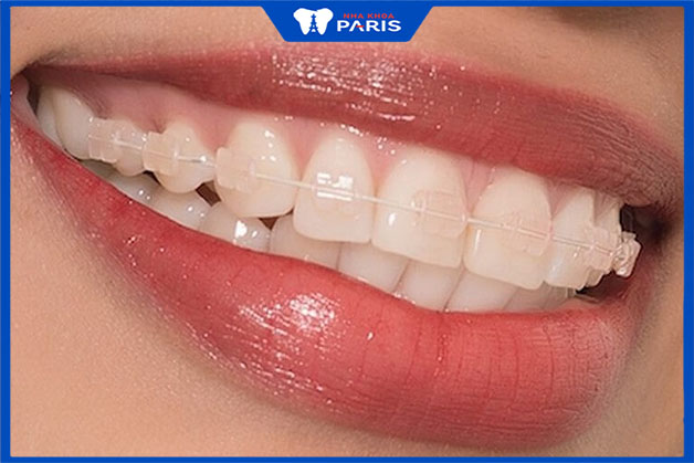 Niềng răng thẩm mỹ ngăn ngừa triệt để các bệnh lý răng miệng