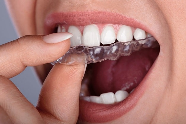 Phương pháp niềng răng trong suốt đảm bảo tính thẩm mỹ cho người dùng
