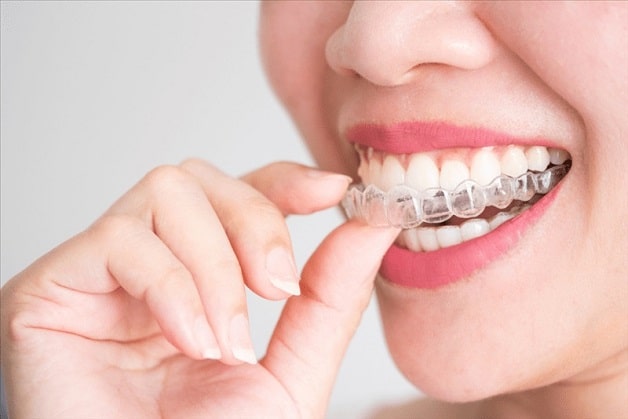 Khay niềng răng thẩm mỹ không mắc cài chất liệu nhựa cao cấp