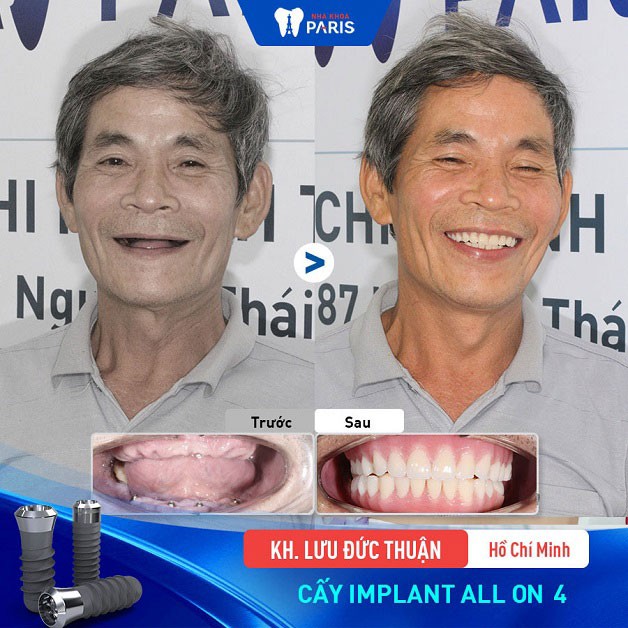 Khách hàng Lưu Đức Thuận lấy lại hàm răng nhờ implant
