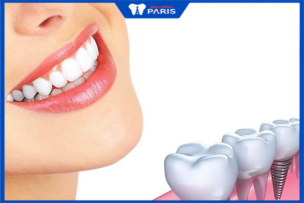 Trụ răng implant có tính thẩm mỹ cao