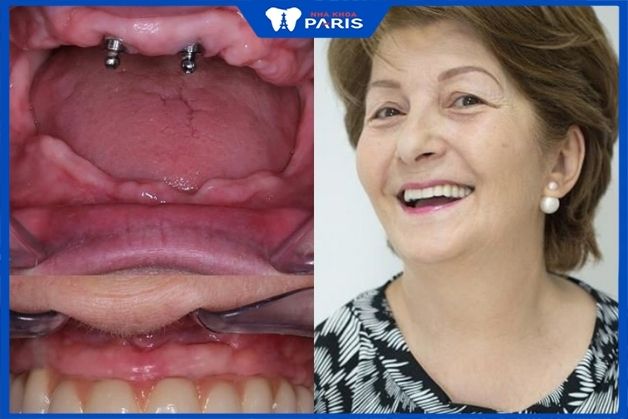 Việt kiều Claire Phạm trồng răng implant tại nha khoa paris