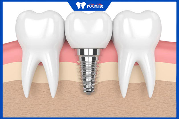Tại sao nên chọn trụ răng implant tại nha khoa Paris