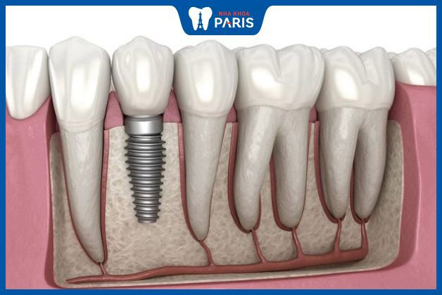 Implant chỉ cắm vào hàm, không ảnh hưởng tới răng xung quanh