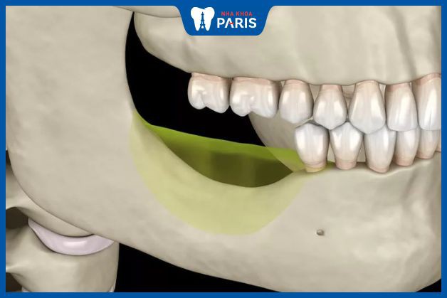Implant giúp ngừa 99% tình trạng tiêu xương răng