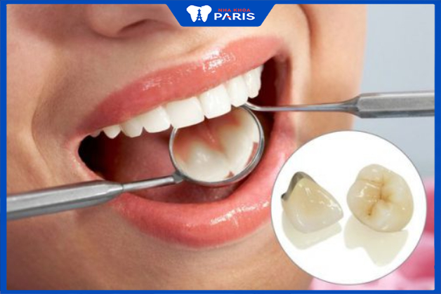 Bọc răng sứ không cẩn thận có thể gây đen viền nướu