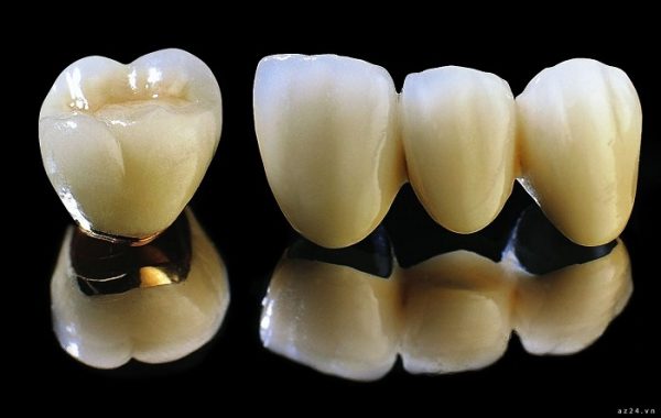 Trường hợp được chỉ định bọc răng sứ Titan