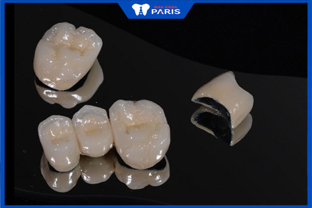 Các loại răng sứ kim loại phổ biến nhất 