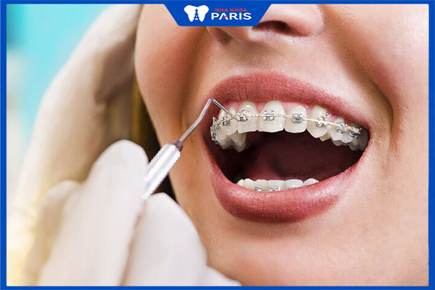 Cách xử lý khi khí cụ niềng răng bị bung tuột hoặc vỡ