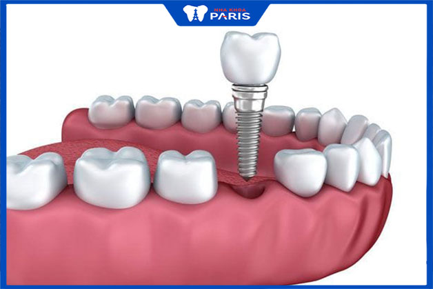 Implant bảo vệ răng, hàm, đảm bảo thẩm mỹ