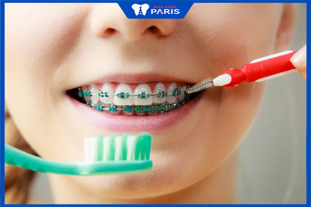 Chăm sóc răng miệng cho trẻ em sau khi niềng răng