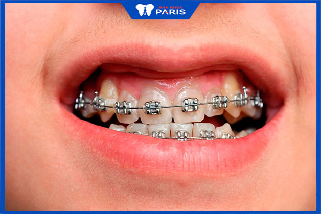 Phương pháp niềng răng chữa cười hở lợi không can thiệp phẫu thuật