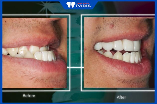 Bọc răng sứ thẩm mỹ giúp cải tình tình trạng răng móm hiệu quả