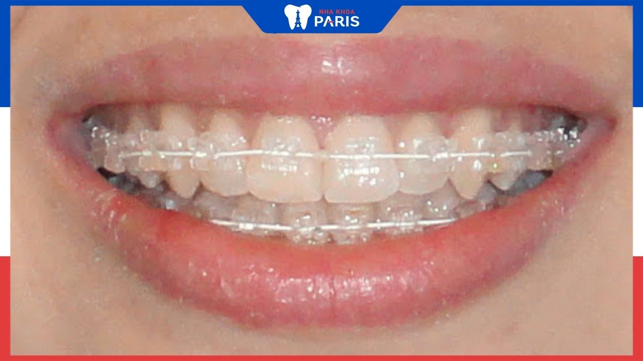 Có nên niềng răng mắc cài pha lê không? Góc độ chuyên gia