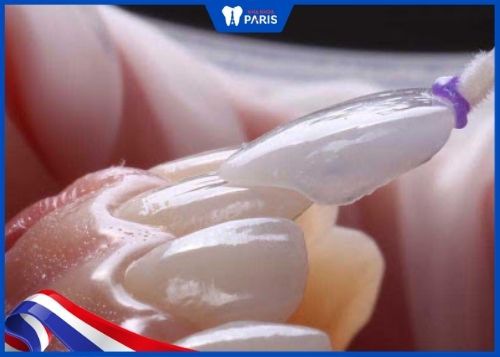 Dán răng sứ thường được chỉ định trong trường hợp răng xỉn màu, ố vàng