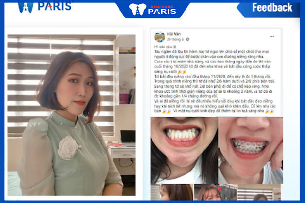 Sự khác biệt rõ rệt trước và sau khi niềng răng tại Paris