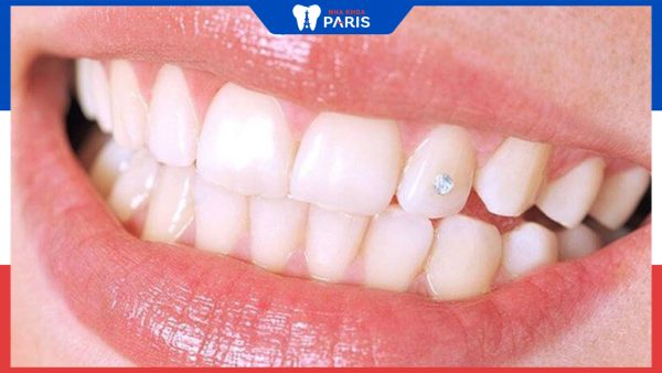 Răng gắn đá – Trào lưu thẩm mỹ giúp nụ cười tỏa nắng