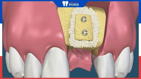 Ghép xương sau khi nhổ răng là gì, áp dụng cho những đối tượng nào?