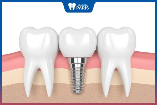 Răng implant không ảnh hưởng xấu tới răng thật