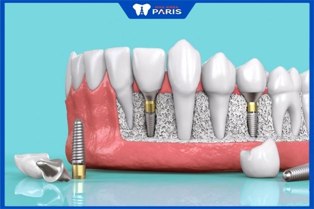 Trụ implant giúp hồi phục chức răng của răng nhanh hơn