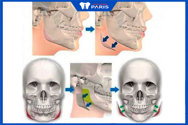 Gọt hàm mặt vuông là kỹ thuật cắt gọt xương hàm giúp khuôn mặt thon gọn, cân đối