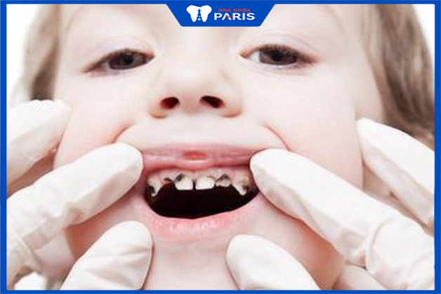 Khám răng định kỳ giúp phát hiện và điều trị các bệnh lý răng miệng kịp thời