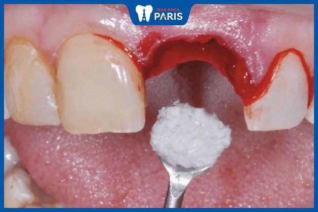 Ghép xương nhằm bổ sung cho hàm có đủ diện tích để trồng răng