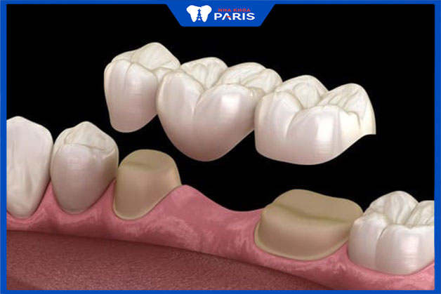 Làm cầu răng sứ tồn tại được bao lâu trên cung hàm