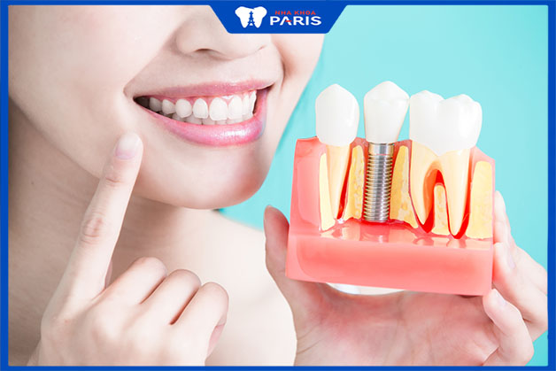 Lý do nên chọn cấy ghép răng Implant tại nha khoa uy tín