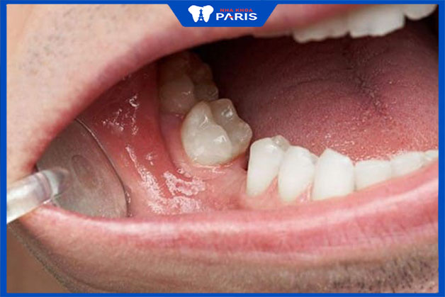 Mất răng lâu năm gây ra tiêu xương hàm