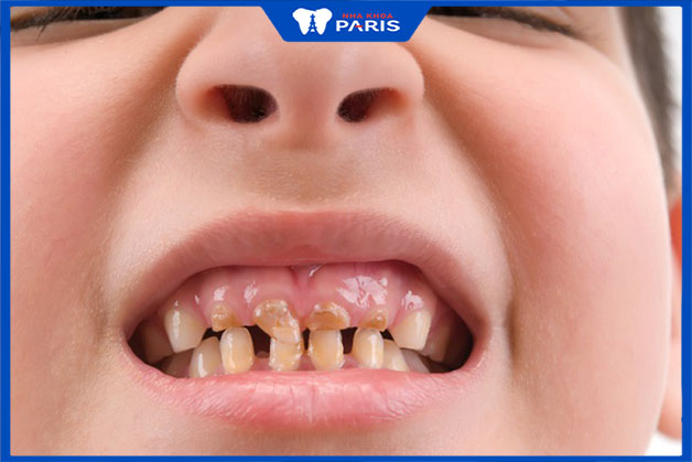 Những vấn đề răng miệng phổ biến ở trẻ nhỏ