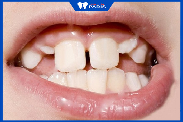 Răng lệch lạc không phải là yếu tố bệnh lý