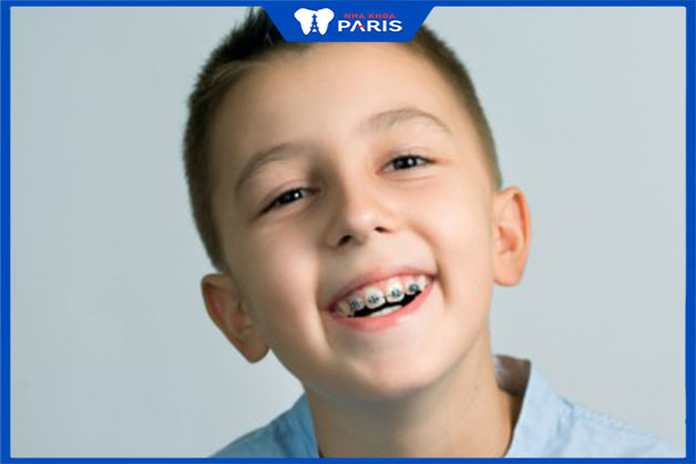 Niềng răng cho trẻ hạn chế tối đa đau nhức