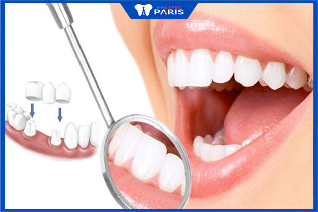Quy trình bọc răng sứ đạt chuẩn quan trọng như thế nào