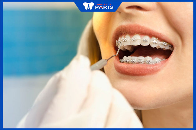 Quy trình niềng răng mắc cài sứ tại nha khoa Paris