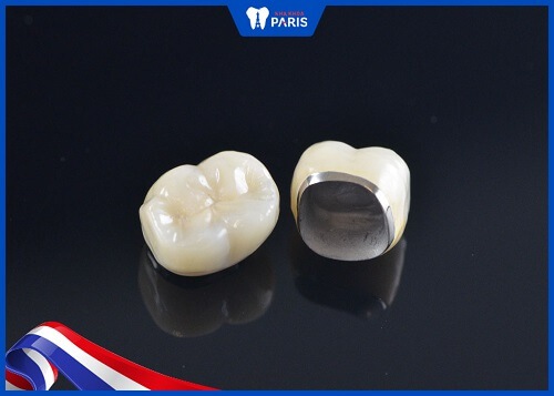 Răng sứ kim loại có chi phí rẻ, tuy nhiên kém thẩm mỹ, dễ bị oxy hóa