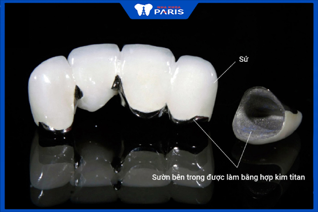 Cấu tạo răng tittan gồm phần sườn là kim loại titan. Phủ bên ngoài là lớp sứ để tăng tính thẩm mỹ