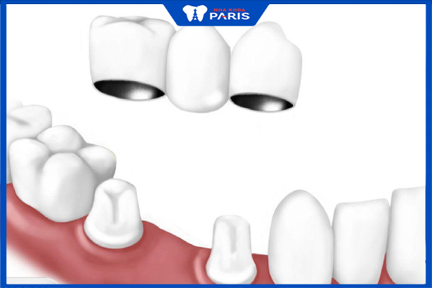 Răng titan được ứng dụng nhiều trong làm cầu răng