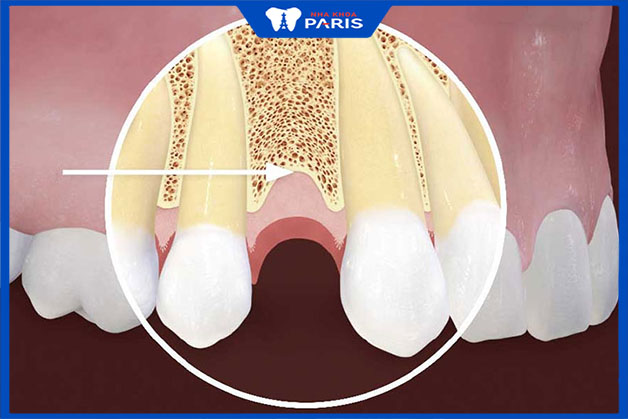 Yêu cầu tình trạng xương như thế nào mới đủ điều kiện trồng răng hàm