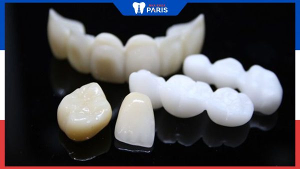 Các loại răng sứ kim loại được dùng phổ biến nhất