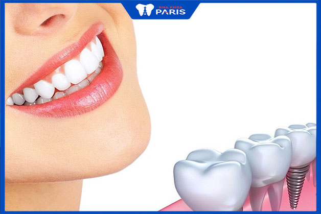 Trồng răng hàm mang lại ưu điểm nổi bật gì