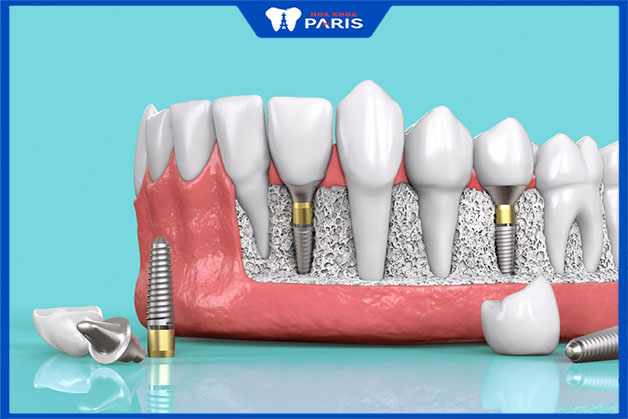Quá trình trồng răng Implant mất bao nhiêu thời gian