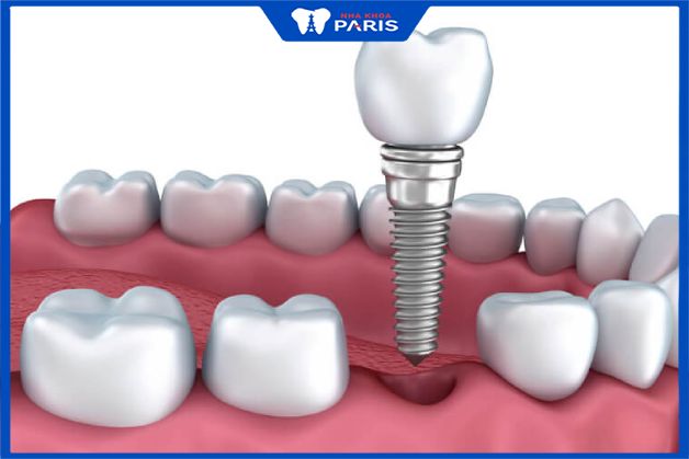 Trồng răng sứ toàn sứ bằng vít implant giúp phục hồi răng mất hiệu quả