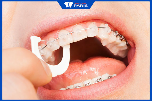 Chăm sóc răng miệng trong và sau khi niềng răng mắc cài tự buộc
