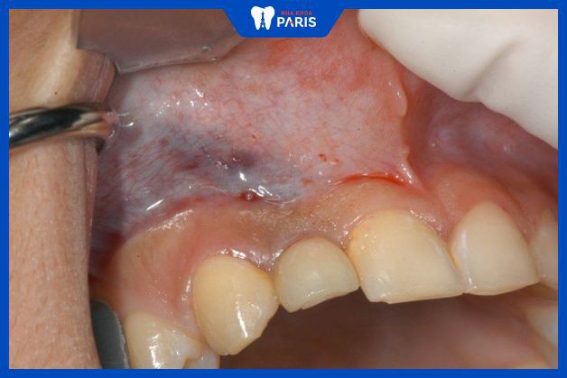 Răng implant bị nhiễm trùng vùng trụ
