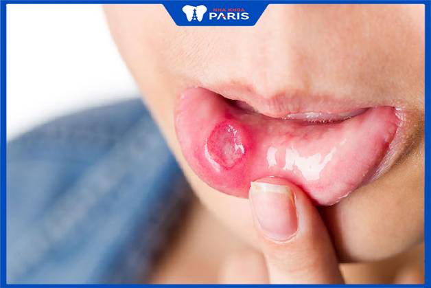 Một số vết thương trong miệng do nhiệt miệt có thể gây hôi miệng
