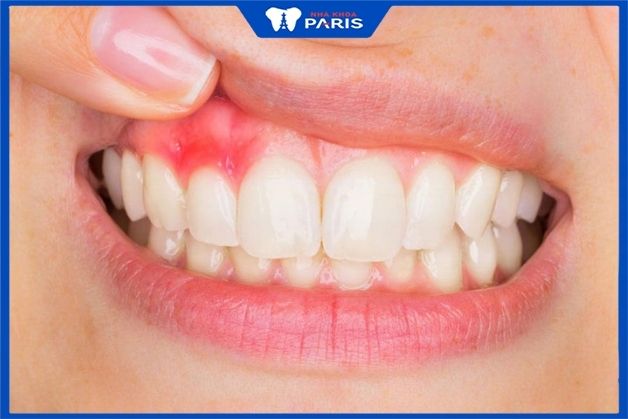 Điều trị dứt điểm tình trạng răng miệng trước khi bọc sứ giúp kéo dài tuổi thọ