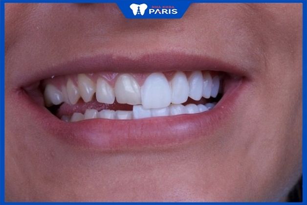 Răng gặp khuyết điểm có thể làm răng sứ không mài