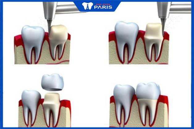 Bọc răng sứ sau khi lấy tủy giúp kéo dài tuổi thọ răng thật